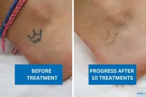 Before and after image showing fading of a crown tattoo on the foot after 10 laser tattoo removal treatments.