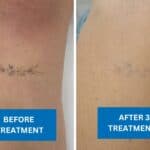 Before and after image showing the progress of tattoo removal treatment.