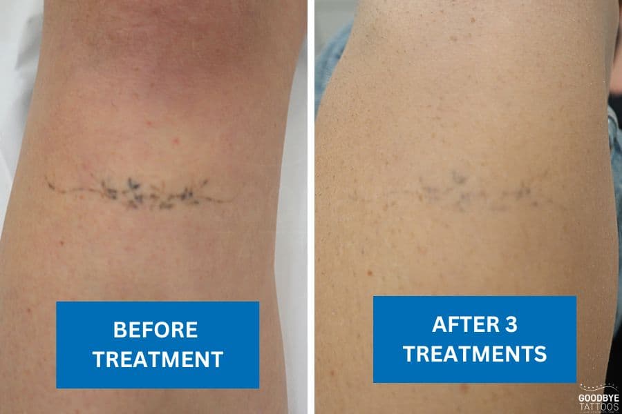 Before and after image showing the progress of tattoo removal treatment.