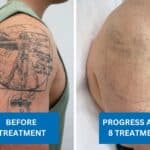 Tattoo removal of Leonardo da Vinci’s Vitruvian Man tattoo showing before and after results