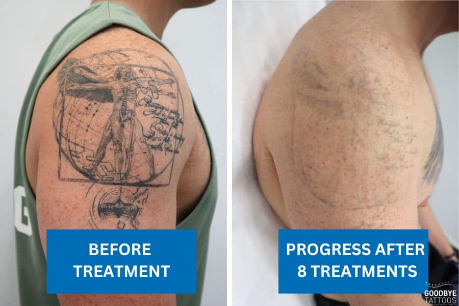 Tattoo removal of Leonardo da Vinci’s Vitruvian Man tattoo showing before and after results