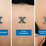 Tattoo removal progress of neck tattoo with the letter X Title: Tattoo removal progress of neck tattoo with the letter X