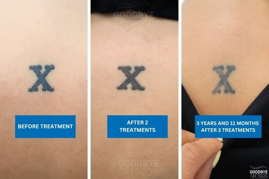 Tattoo removal progress of neck tattoo with the letter X Title: Tattoo removal progress of neck tattoo with the letter X