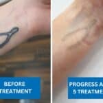 Tattoo removal progress of a wishbone tattoo on wrist after five laser sessions
