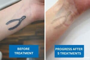 Tattoo removal progress of a wishbone tattoo on wrist after five laser sessions