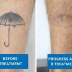 tattoo removal showing before and after comparison on a person's leg
