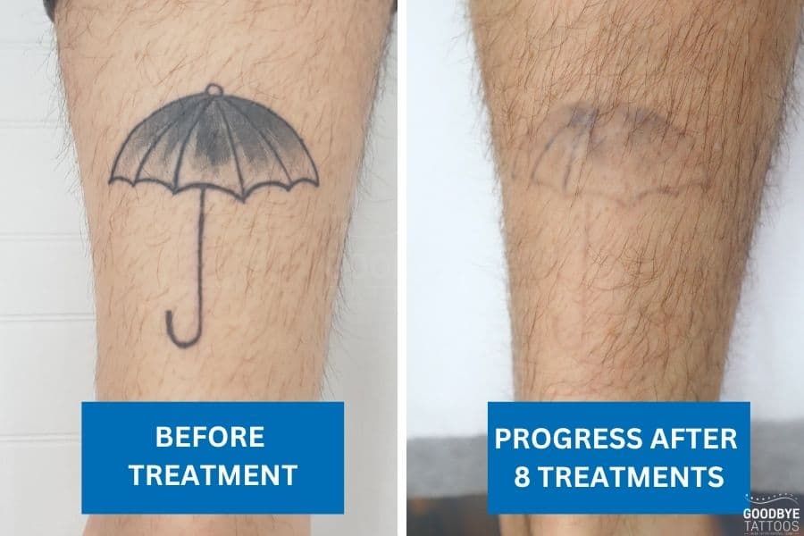 tattoo removal showing before and after comparison on a person's leg