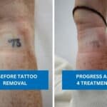 Laser progress showing wrist tattoo removal before and after four sessions