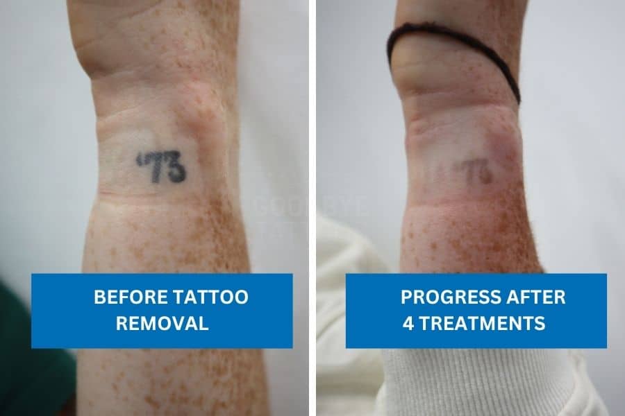 Laser progress showing wrist tattoo removal before and after four sessions