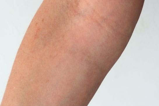 Showing faded forearm skin after all-good-things-tattoo-removal treatment with reduced visible tattoo ink.