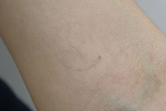 Showing faded crescent moon face tattoo removal on an arm with softened ink and reduced outline visibility.