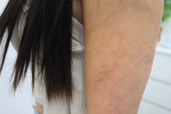 Showing faded botanical arm tattoo removal with softened leafy outlines and reduced ink visibility.
