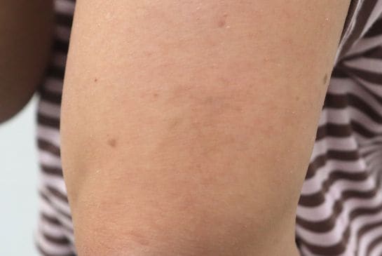 Showing faded airplane outline tattoo removal near the elbow after 8 sessions with minimal remaining ink.