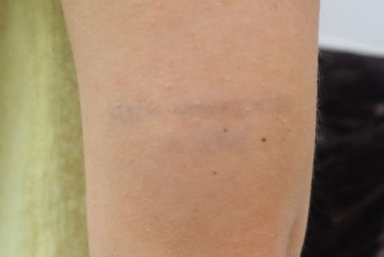 Showing faded tricep quote tattoo removal after 9 sessions with minimal remaining text visibility.