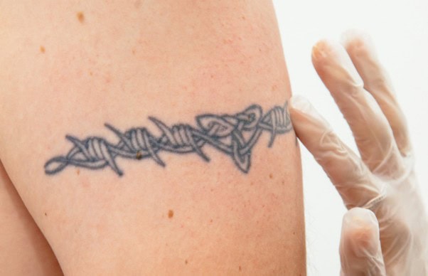 Showing a clinician assessing an upper arm tattoo before creating a tailored laser tattoo removal treatment plan.