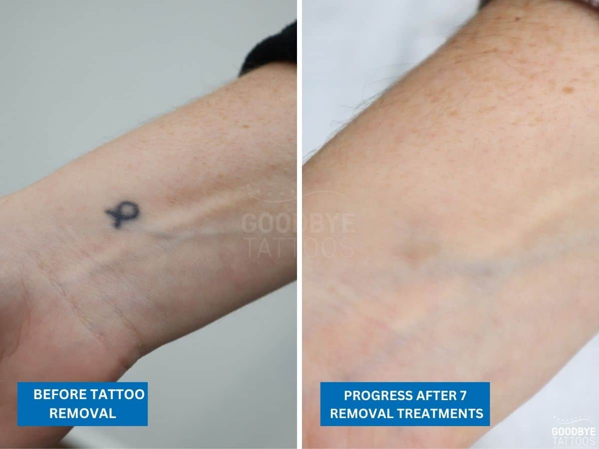 Tattoo Removal Treatment Progress